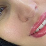 میکروپیگمنتیشن