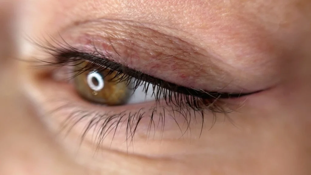 عوارض بن مژه چیست