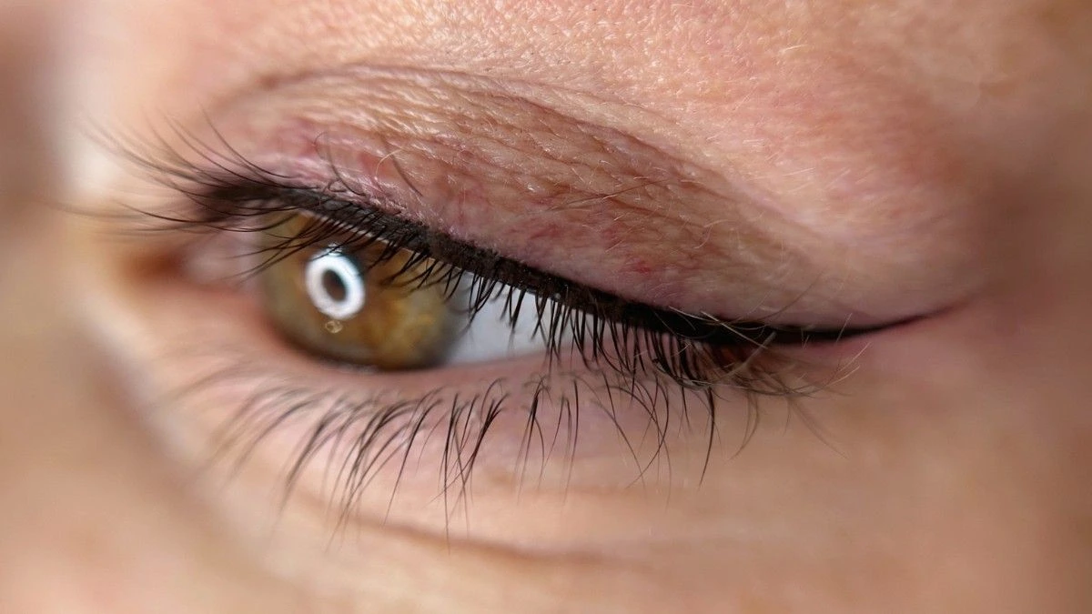 عوارض بن مژه چیست