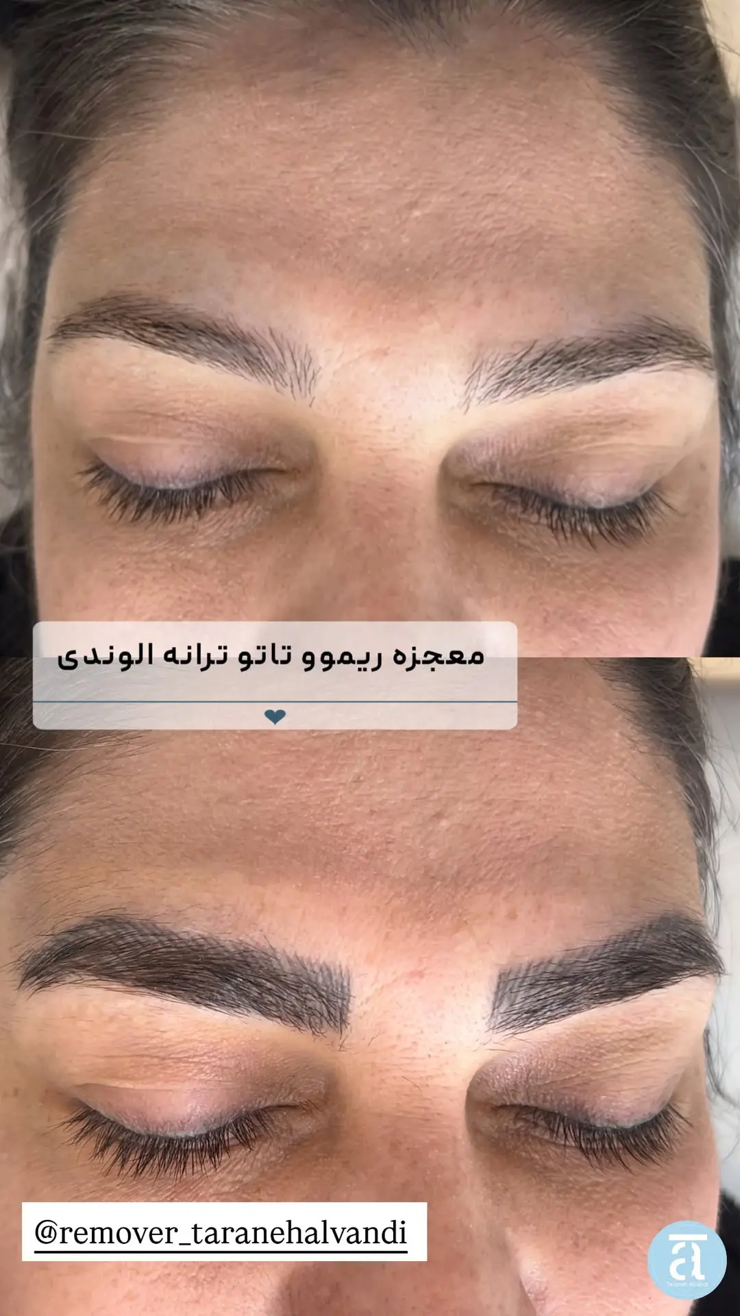عکس ریمو ابرو با مواد