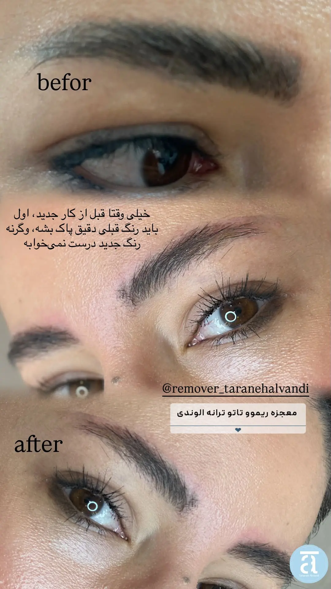 عکس قبل و بعد از ریمو ابرو