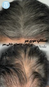 برآورد هزینه و قیمت اسکالپ سر