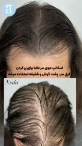 مهمترین عوامل تعیینکننده هزینه اسکالپ سر