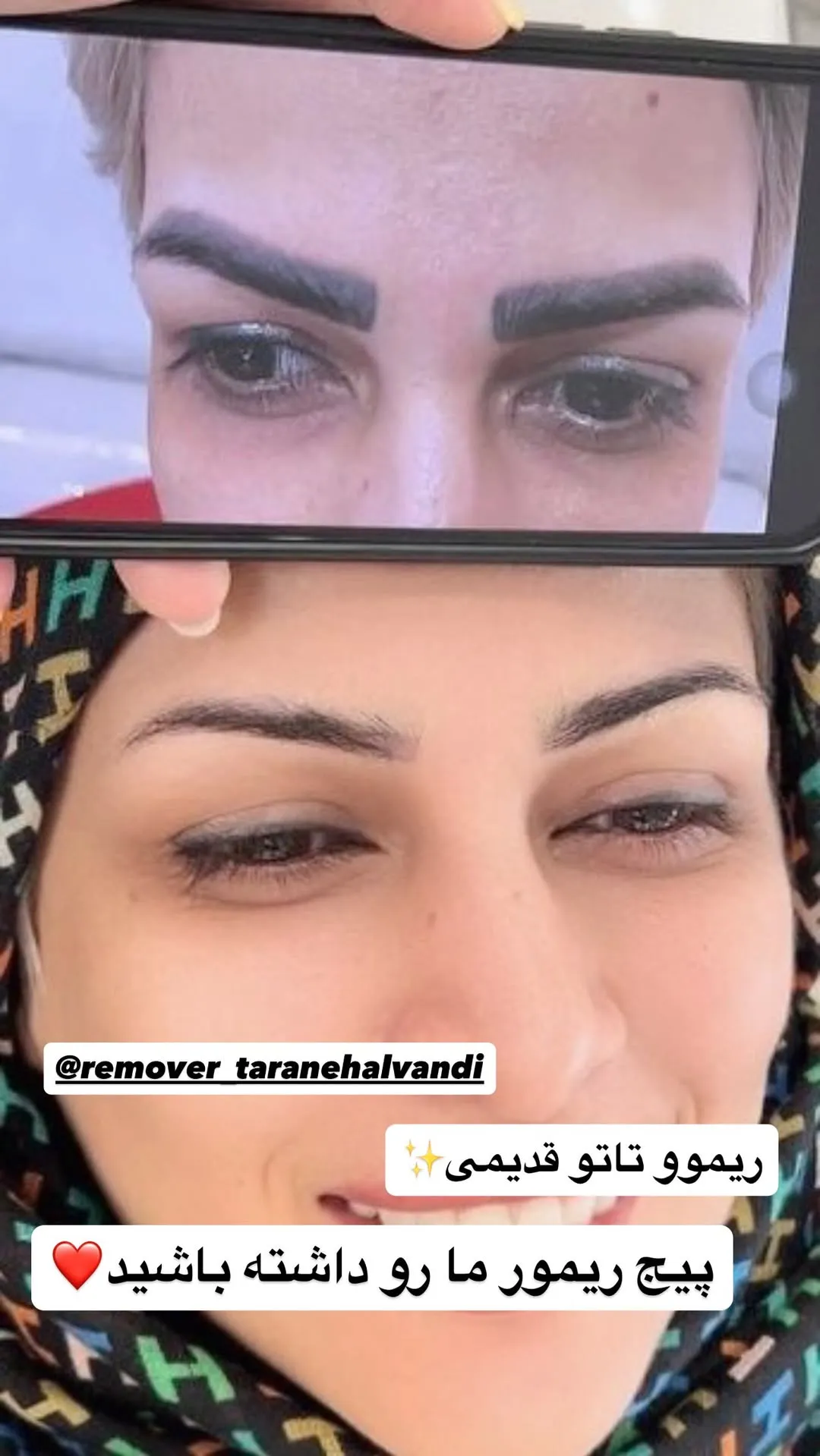 عکس بعد از ریموو ابرو