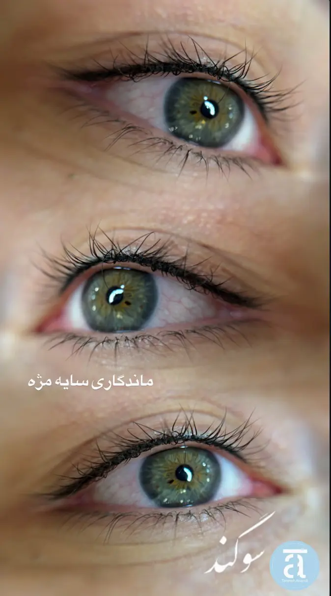 عکس بن مژه قبل و بعد کلینیک زیبایی ترانه الوندی
