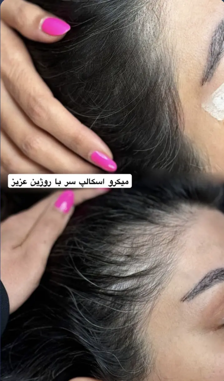 عکس اسکالپ موی سر نمونه کار اسکالپ کلینیک زیبایی ترانه الوندی